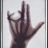 Albert Londe「X-ray of hand with congenital deformation」